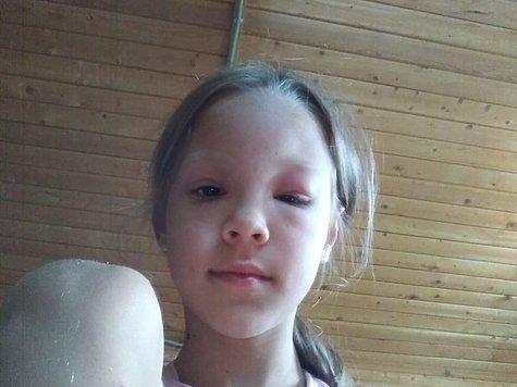 Мужчина перепутал пчелиные укусы с пулевыми ранениями